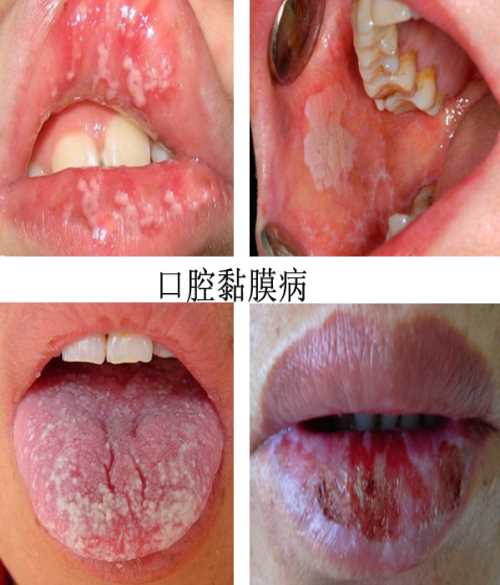 急性假膜型念珠菌口炎是指因白色念珠菌感染所患的口腔黏膜组织的炎